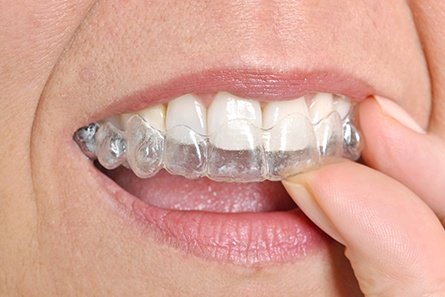 Invisalign3.jpg