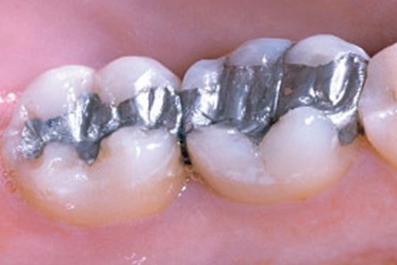 fillings1.jpg